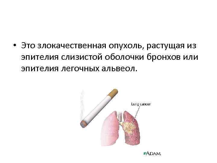  • Это злокачественная опухоль, растущая из эпителия слизистой оболочки бронхов или эпителия легочных