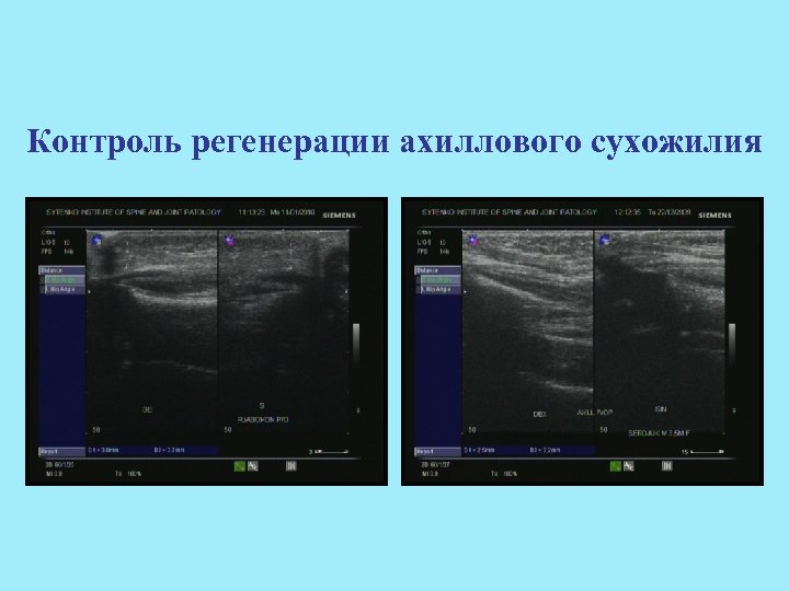 Контроль регенерации ахиллового сухожилия 