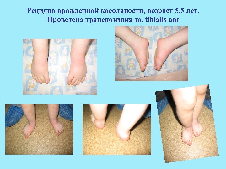 Рецидив врожденной косолапости, возраст 5, 5 лет. Проведена транспозиция m. tibialis ant 