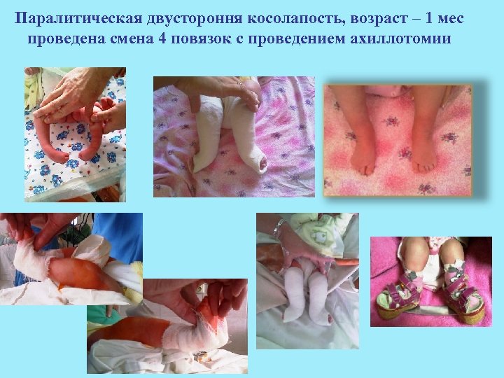 Паралитическая двустороння косолапость, возраст – 1 мес проведена смена 4 повязок с проведением ахиллотомии