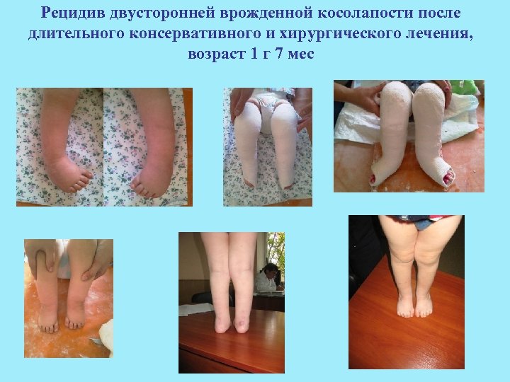 Рецидив двусторонней врожденной косолапости после длительного консервативного и хирургического лечения, возраст 1 г 7