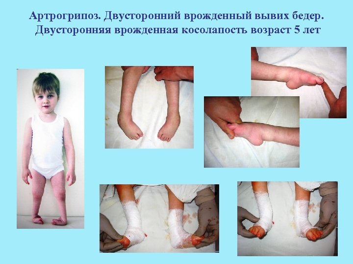 Артрогрипоз. Двусторонний врожденный вывих бедер. Двусторонняя врожденная косолапость возраст 5 лет 