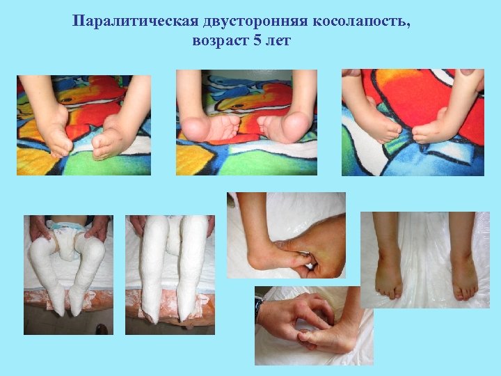 Паралитическая двусторонняя косолапость, возраст 5 лет 