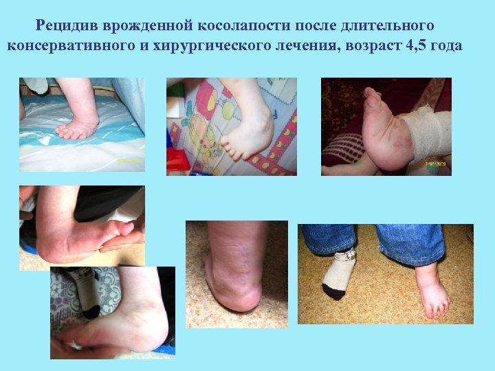 Рецидив врожденной косолапости после длительного консервативного и хирургического лечения, возраст 4, 5 года 