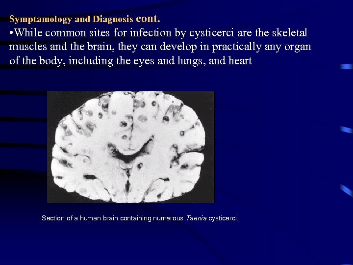 Symptamology and Diagnosis cont. • While common sites for infection by cysticerci are the