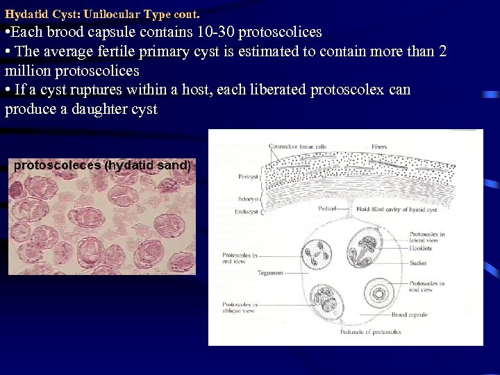 Hydatid Cyst: Unilocular Type cont. • Each brood capsule contains 10 -30 protoscolices •