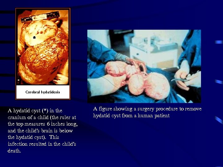 A hydatid cyst (*) in the cranium of a child (the ruler at the