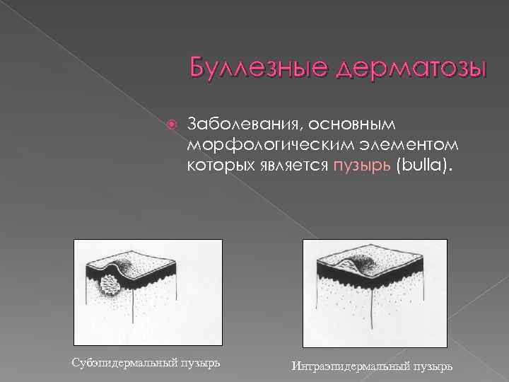 Буллезные дерматозы Заболевания, основным морфологическим элементом которых является пузырь (bulla). Субэпидермальный пузырь Интраэпидермальный пузырь