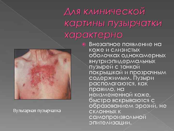 Для клинической картины пузырчатки характерно Вульгарная пузырчатка Внезапное появление на коже и слизистых оболочках