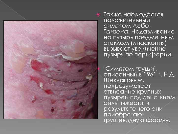  Также наблюдается положительный симптом Асбо. Ганзена. Надавливание на пузырь предметным стеклом (диаскопия) вызывает
