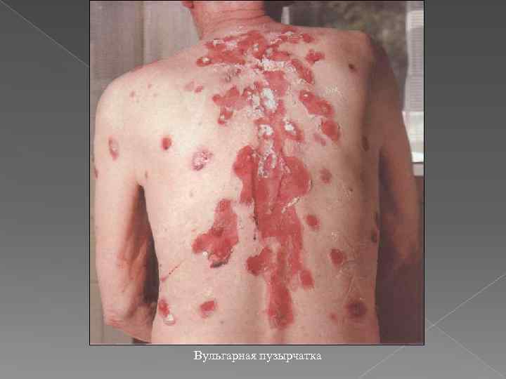 Вульгарная пузырчатка 