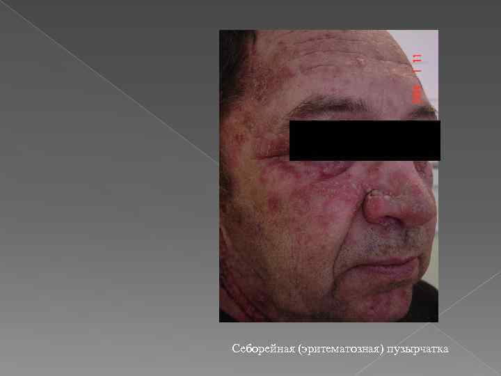 Себорейная (эритематозная) пузырчатка 