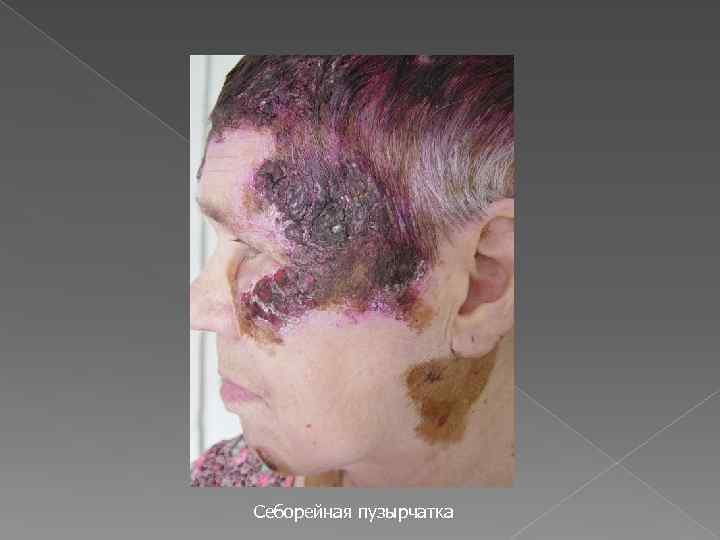 Себорейная пузырчатка 
