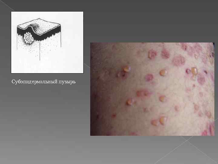 Субэпидермальный пузырь 