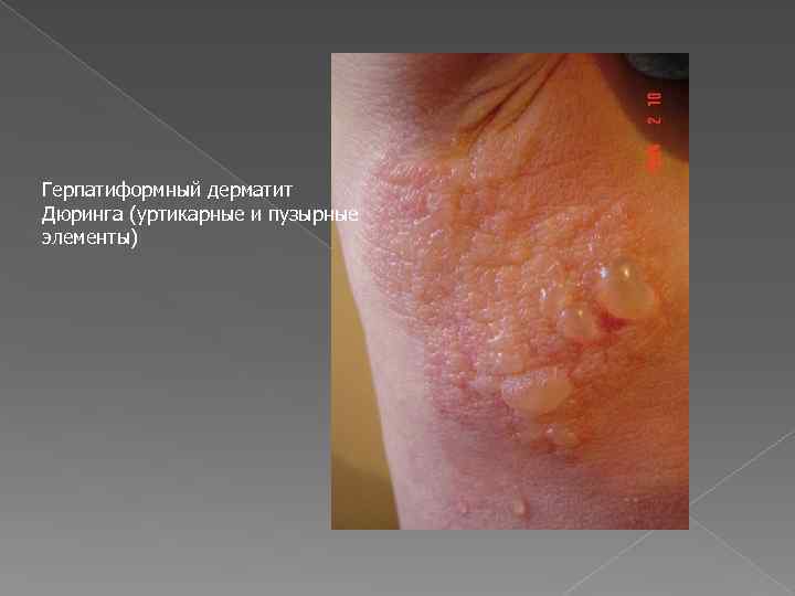 Герпатиформный дерматит Дюринга (уртикарные и пузырные элементы) 