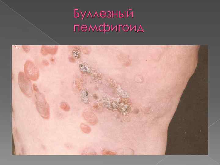 Буллезный пемфигоид 