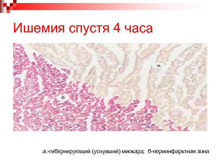 Ишемия спустя 4 часа а. -гибернирующий (уснувший) миокард; б-периинфарктная зона 