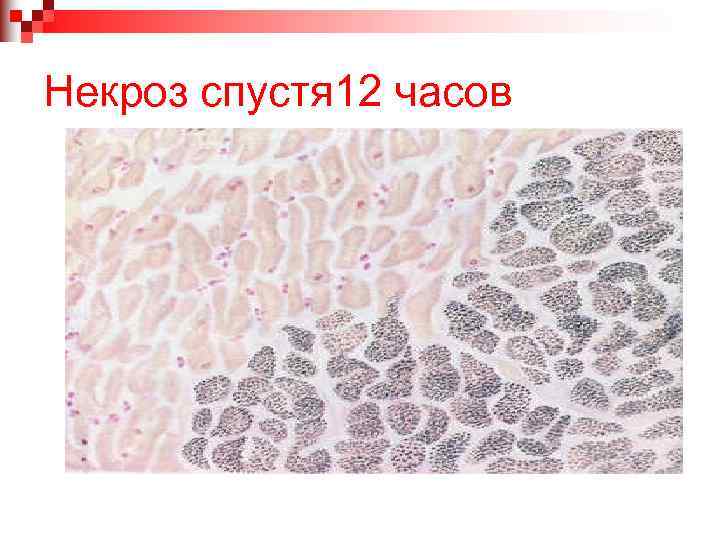 Некроз спустя 12 часов 