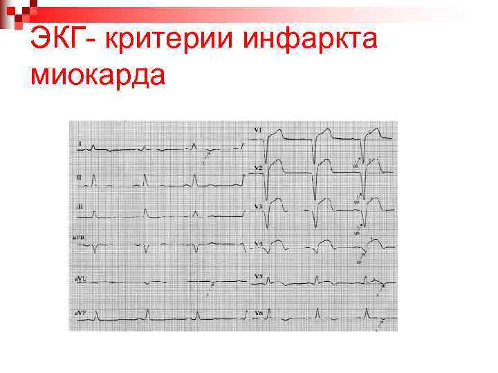 ЭКГ- критерии инфаркта миокарда 