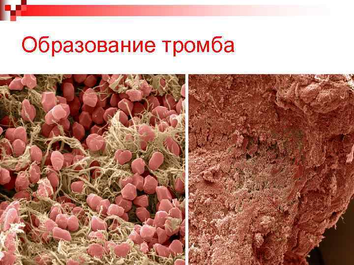 Образование тромба 