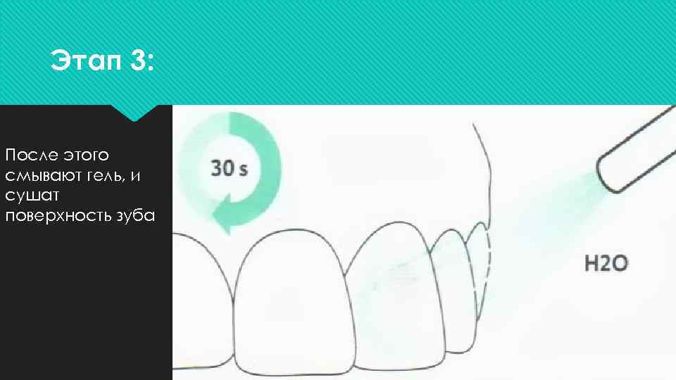 Протокол лечения кариеса. Этапы очистки поверхности зуб. Инфильтрация методика. Методика инфильтрации «icon». Поверхность зубов покрыта.