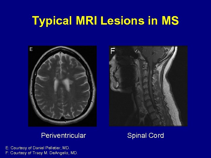 Typical MRI Lesions in MS Periventricular E: Courtesy of Daniel Pelletier, MD. F: Courtesy
