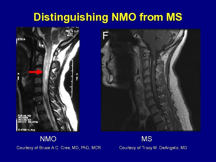 Distinguishing NMO from MS NMO Courtesy of Bruce A. C. Cree, MD, Ph. D,