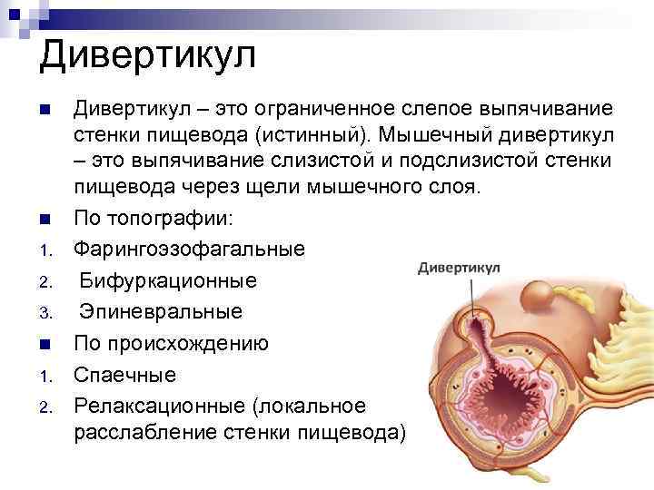 Дивертикул n n 1. 2. 3. n 1. 2. Дивертикул – это ограниченное слепое