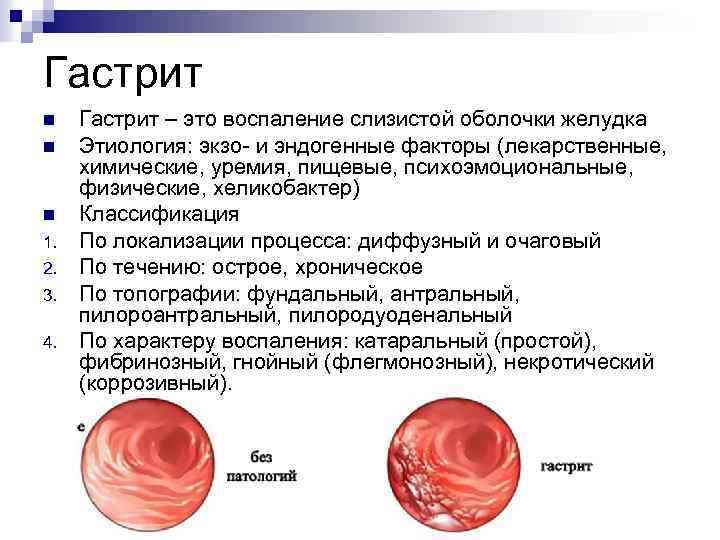Гастрит n n n 1. 2. 3. 4. Гастрит – это воспаление слизистой оболочки