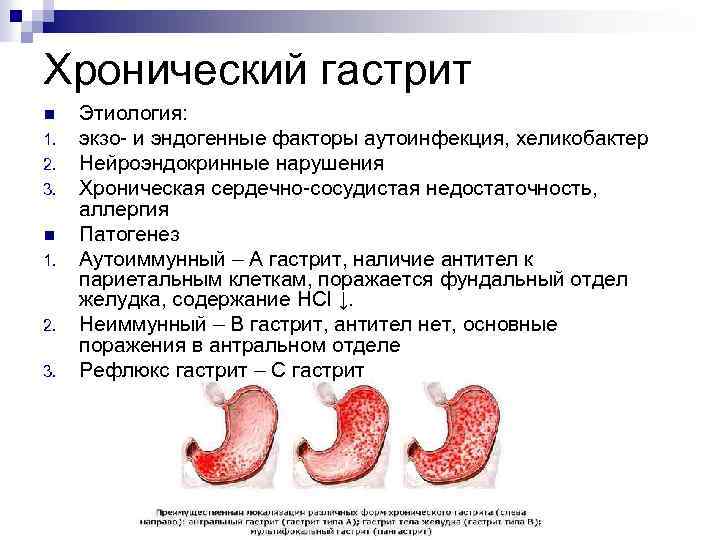 Хронический гастрит n 1. 2. 3. n 1. 2. 3. Этиология: экзо- и эндогенные
