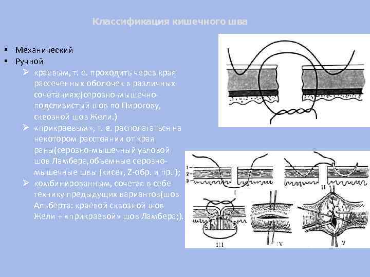 Классификация кишечного шва § Механический § Ручной Ø краевым, т. е. проходить через края