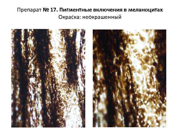 Препарат № 17. Пигментные включения в меланоцитах Окраска: неокрашенный 