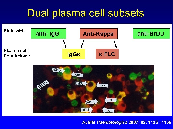 Dual plasma cell subsets Stain with: Plasma cell Populations: anti- Ig. G Anti-Kappa Ig.