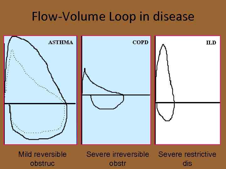 Flow-Volume Loop in disease ASTHMA Mild reversible obstruc COPD ILD Severe irreversible obstr Severe