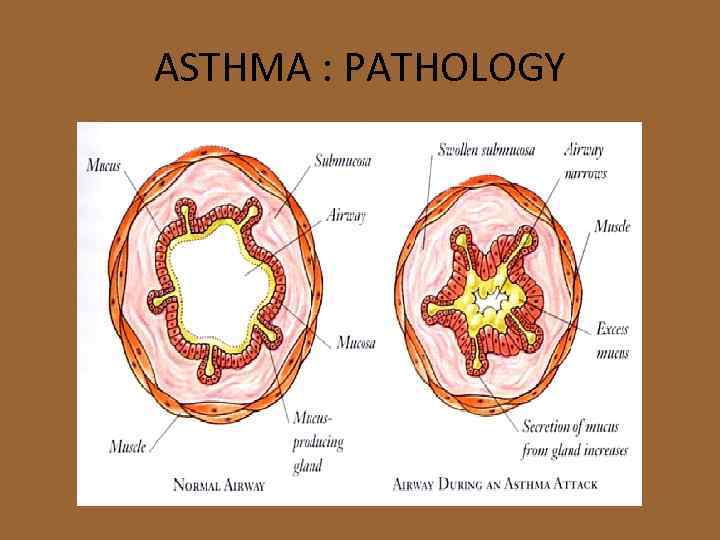 ASTHMA : PATHOLOGY 
