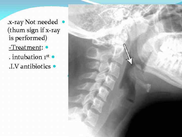 . x-ray Not needed (thum sign if x-ray is performed) -Treatment: . intubation 1