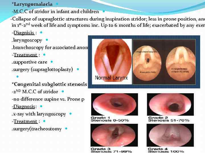 *Laryngomalacia -M. C. C of stridor in infant and children -Collapse of supraglottic structures