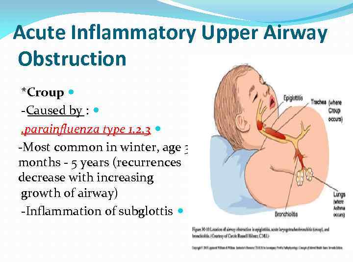 Acute Inflammatory Upper Airway Obstruction *Croup -Caused by : . parainfluenza type 1, 2,