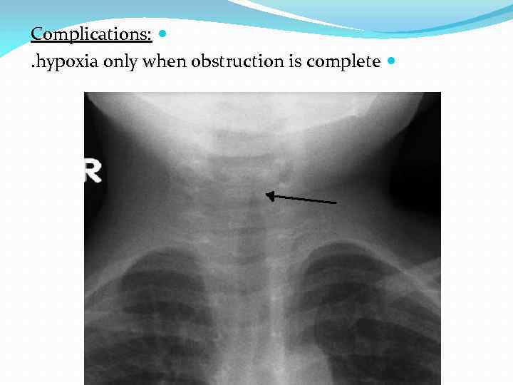 Complications: . hypoxia only when obstruction is complete 