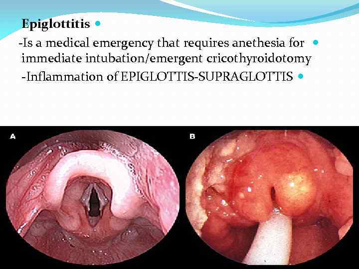 Epiglottitis -Is a medical emergency that requires anethesia for immediate intubation/emergent cricothyroidotomy -Inflammation of