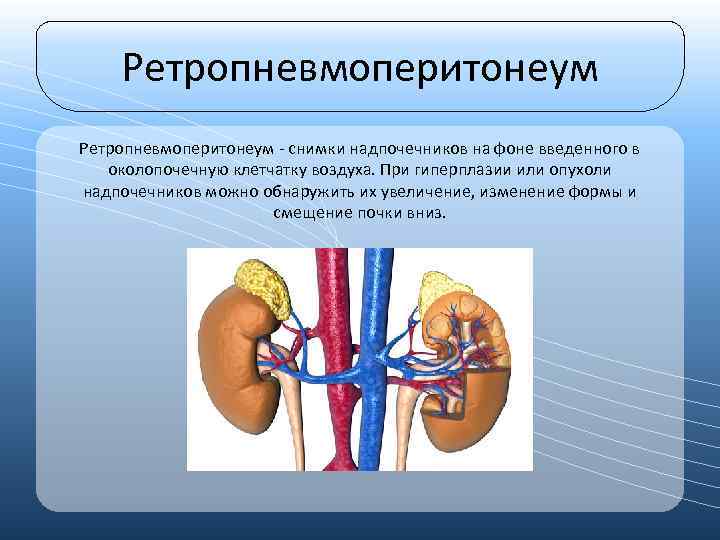 Ретропневмоперитонеум - снимки надпочечников на фоне введенного в околопочечную клетчатку воздуха. При гиперплазии или