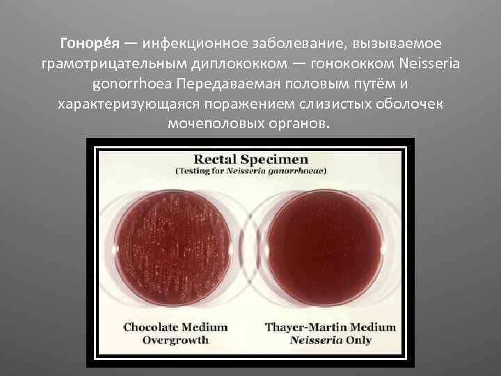 Гоноре я — инфекционное заболевание, вызываемое грамотрицательным диплококком — гонококком Neisseria gonorrhoea Передаваемая половым