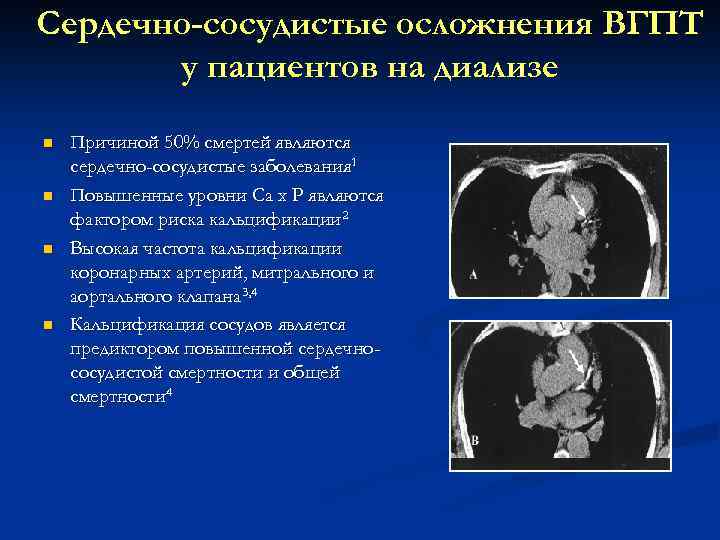Сердечно-сосудистые осложнения ВГПТ у пациентов на диализе n n Причиной 50% смертей являются сердечно-сосудистые