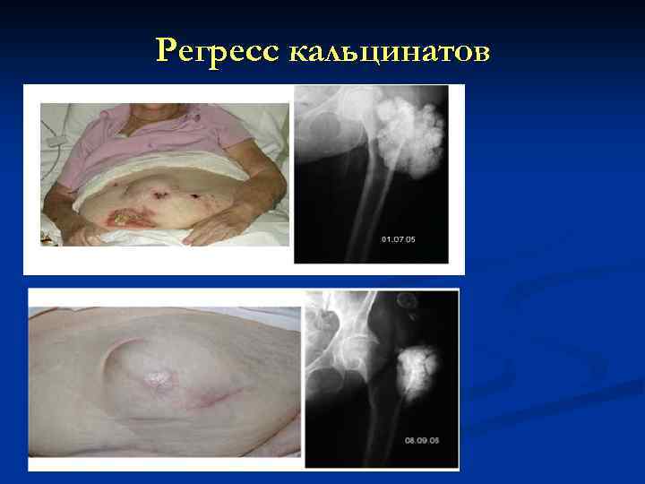 Регресс кальцинатов 