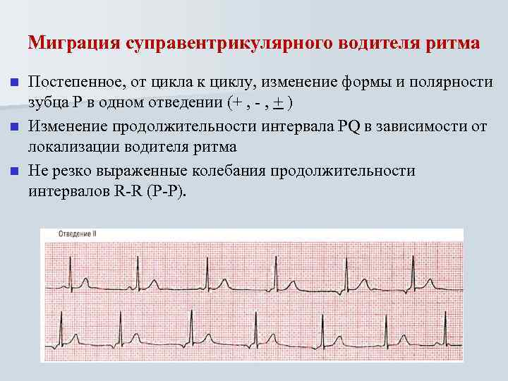 Миграция суправентрикулярного водителя ритма Постепенное, от цикла к циклу, изменение формы и полярности зубца