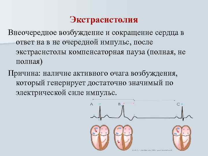 Экстрасистолия Внеочередное возбуждение и сокращение сердца в ответ на в не очередной импульс, после