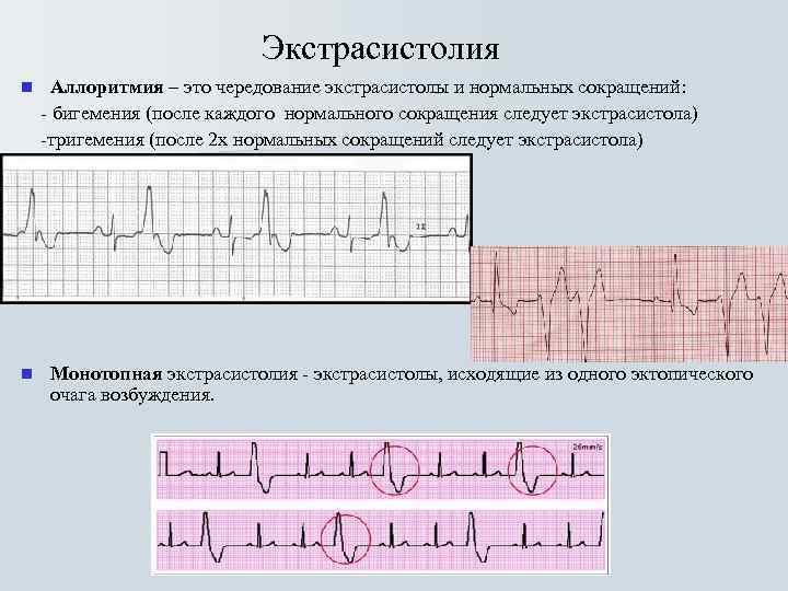 Экстрасистолия n n Аллоритмия – это чередование экстрасистолы и нормальных сокращений: - бигемения (после