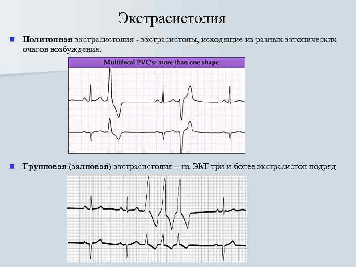 Экстрасистолия n Политопная экстрасистолия - экстрасистолы, исходящие из разных эктопических очагов возбуждения. n Групповая