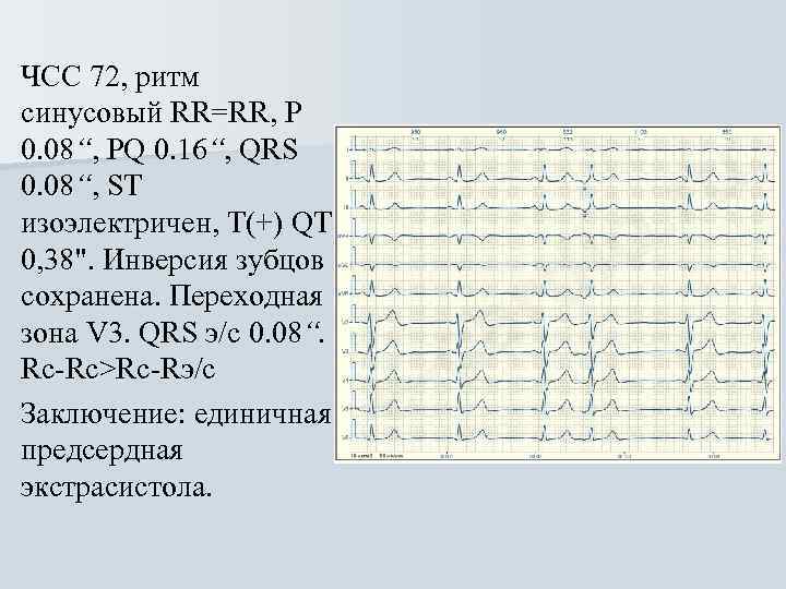 ЧСС 72, ритм синусовый RR=RR, Р 0. 08“, PQ 0. 16“, QRS 0. 08“,