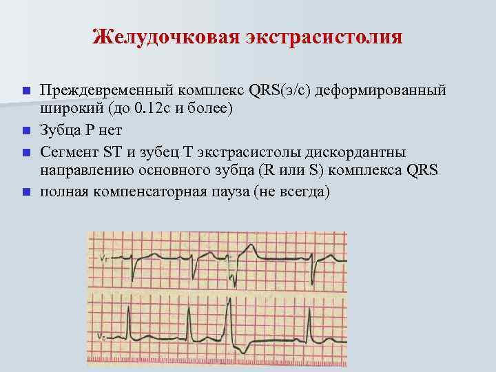 Желудочковая экстрасистолия n n Преждевременный комплекс QRS(э/с) деформированный широкий (до 0. 12 с и